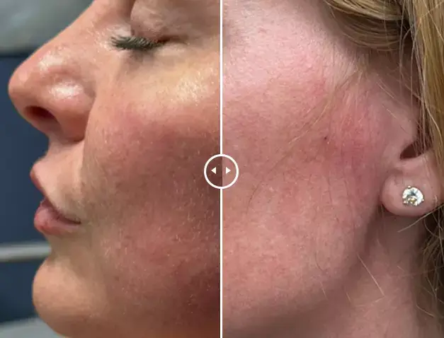 endolift.BeforeAfter four