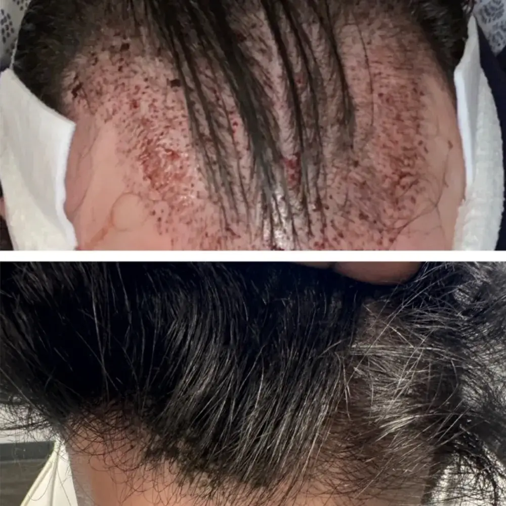 Hairgrafting before after 2