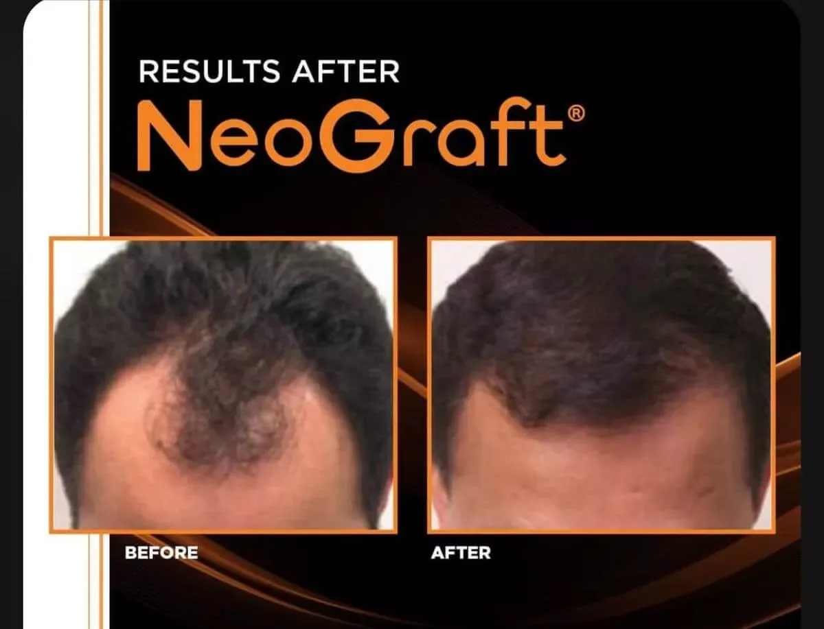 Hair-Transplant-before-after-five-gentle-giant-care-llc-CA