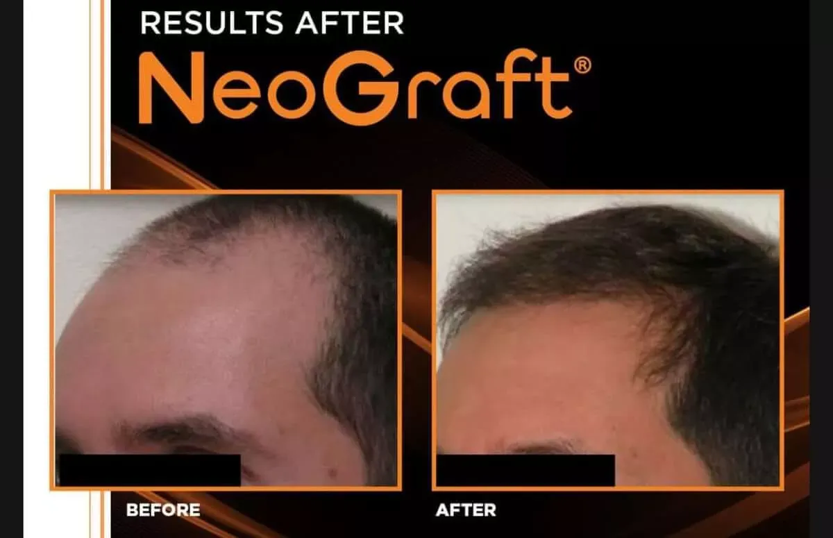 Hair-Transplant-before-after-four-gentle-giant-care-llc-in-atlanta-ga