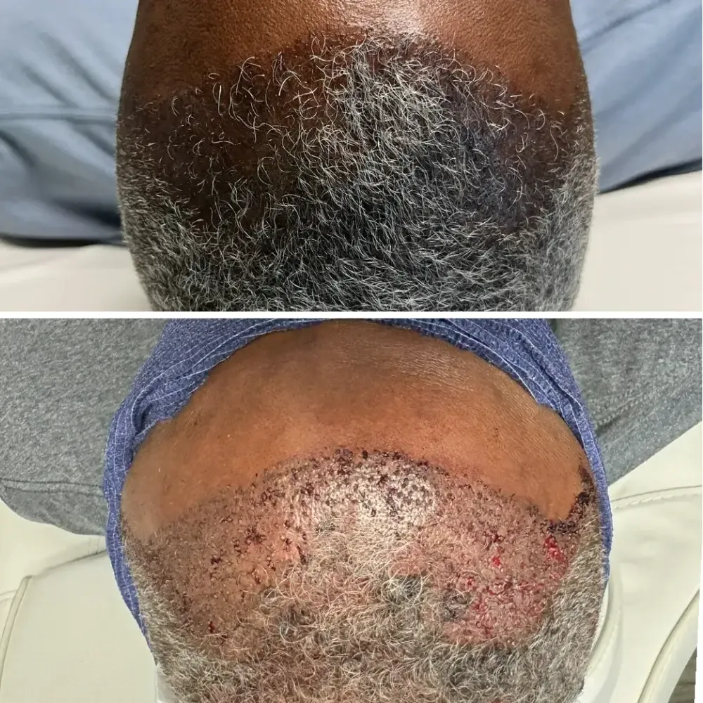 Hair-Transplant-before-after-one-gentle-giant-care-llc-in-atlanta-ga