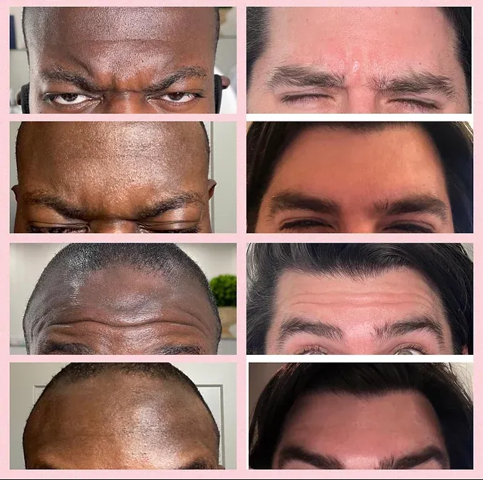 botox-image-gallery-three-gentle-giant-care-in-beverly-hills-ca