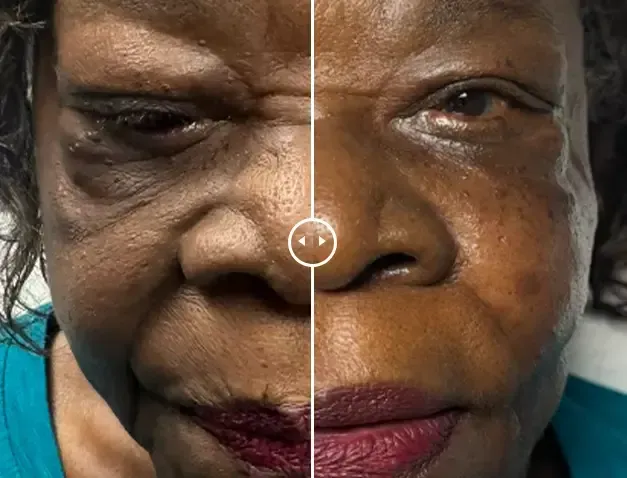 Endolift®-before-after-eight-gentle-giant-care-llc-CA