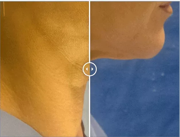 Endolift®-before-after-five-gentle-giant-care-llc-CA