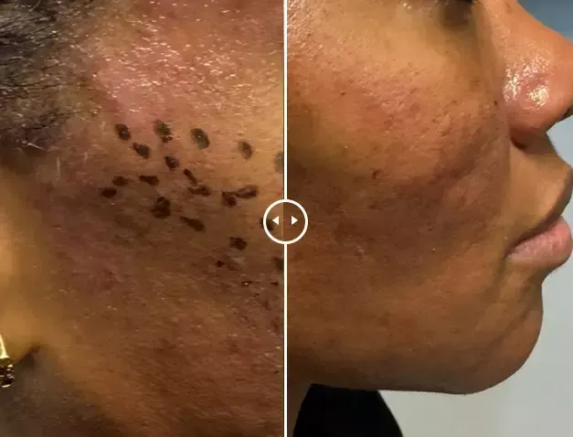 Endolift®-before-after-four-gentle-giant-care-llc-CA-in-palm-springs-ca