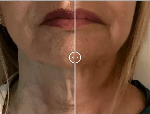Endolift®-before-after-two-gentle-giant-care-llc-CA
