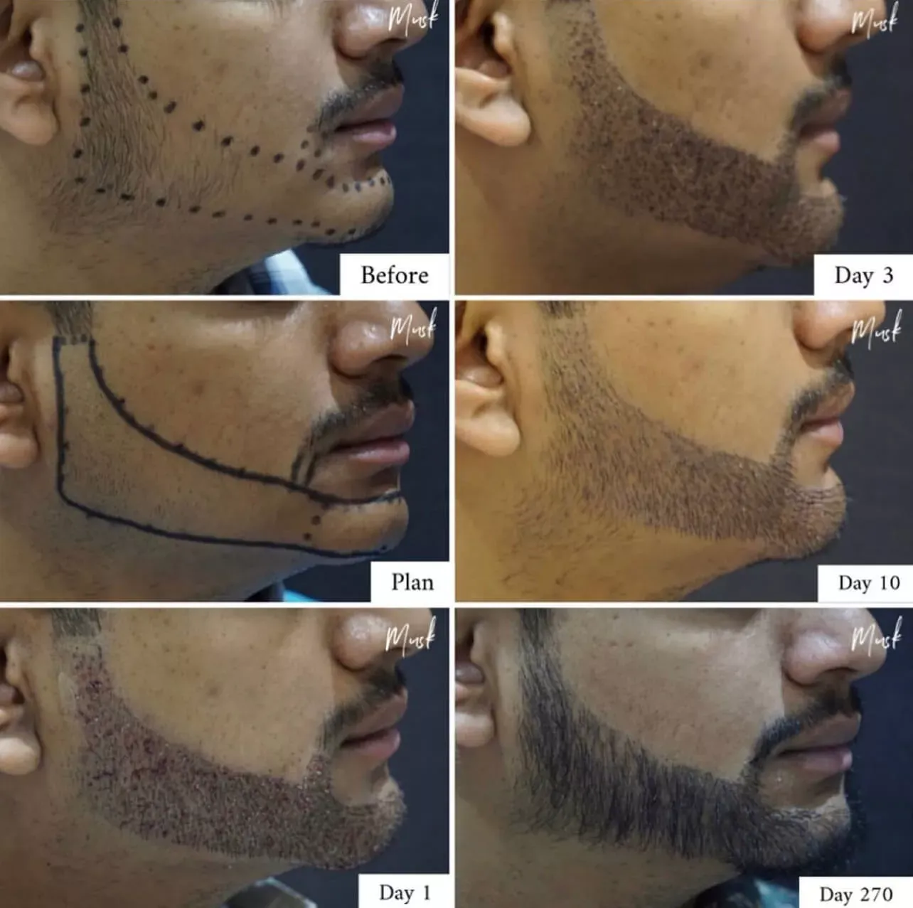 Hair-restoration-before-after-seven-gentle-giant-care-llc-palm-springs-ca