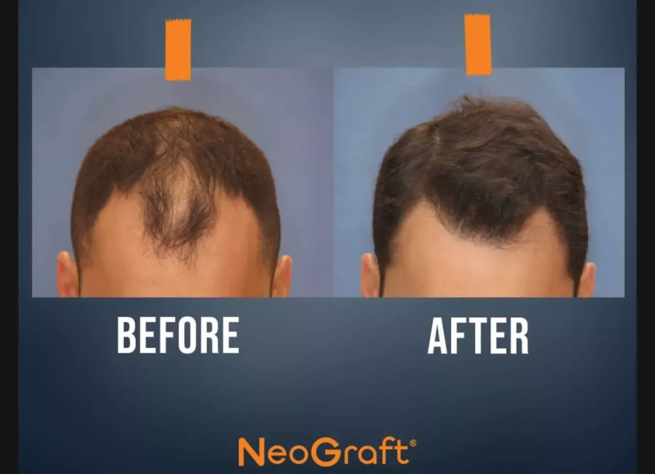 Hair-restoration-before-after-six-gentle-giant-care-llc-atlanta-ga.