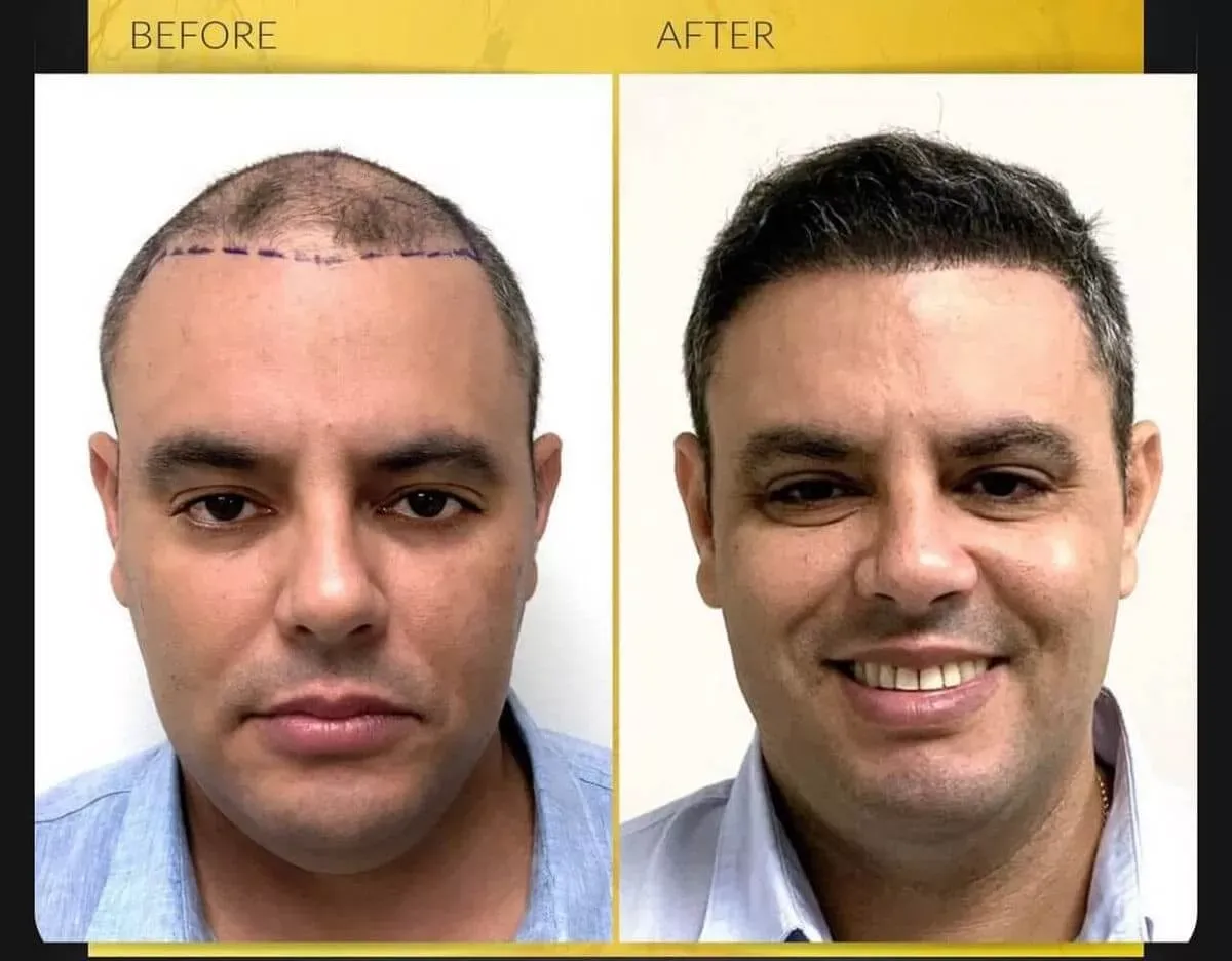 Hair-restoration-before-after-three-gentle-giant-care-llc-palm-springs-ca.