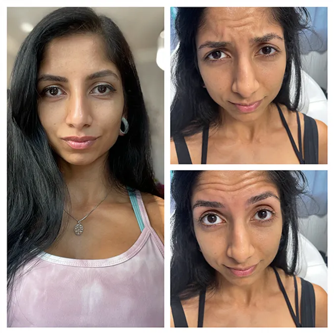 botox-image-gallery-two-gentle-giant-care-in-palm-springs-ca