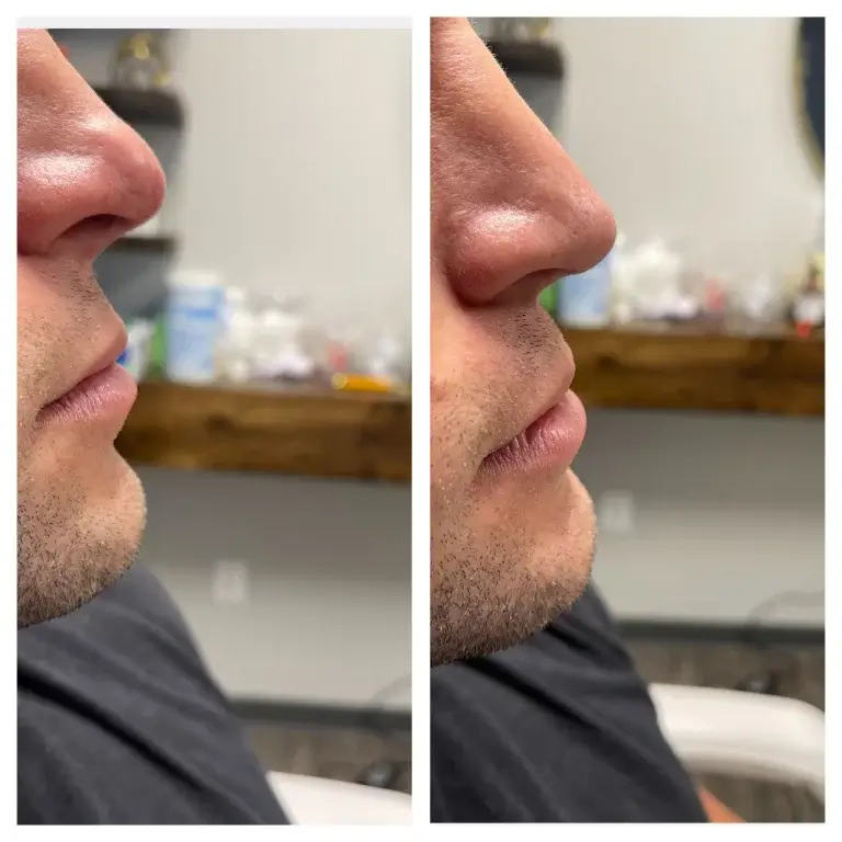 dermal-filler-before-after-one-gentle-giant-care-llc-in-beverly-hills-ca