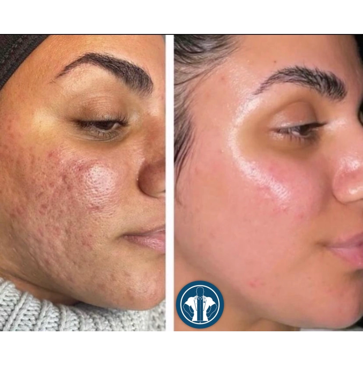 Acne scarring