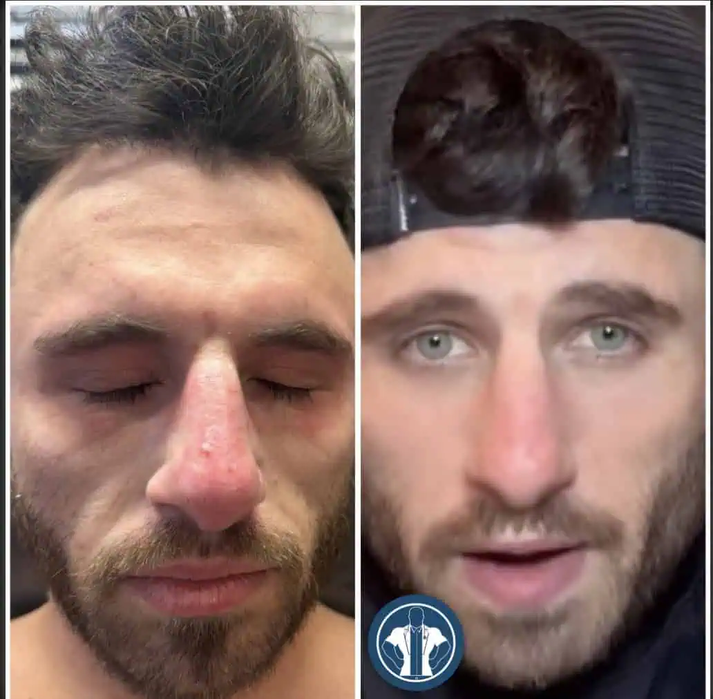 Acne&melasmagentle-giant-care-before-after-one