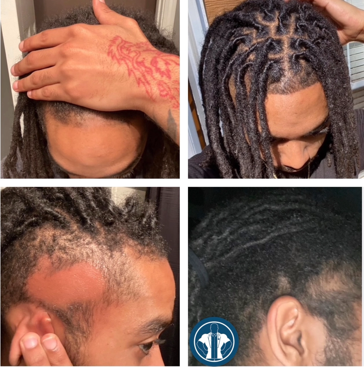 Alopecia