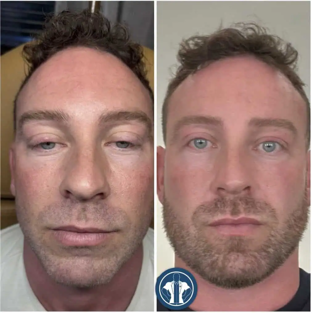 Eye lift gentle-giant-care-before-after-two