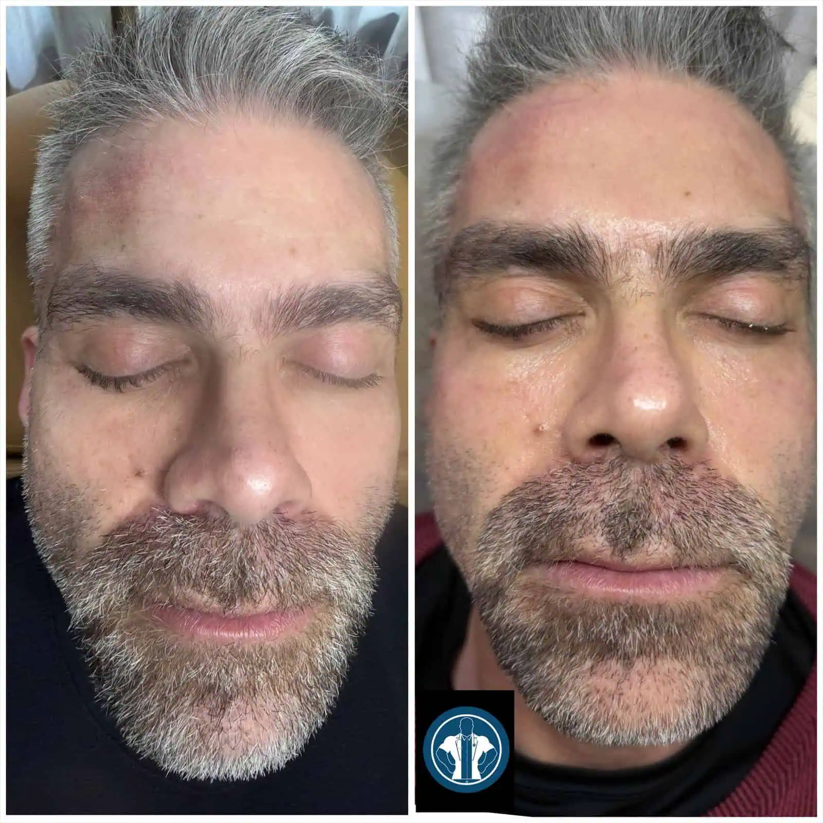 NOUVADerm™-Treatment-Before-After (2)