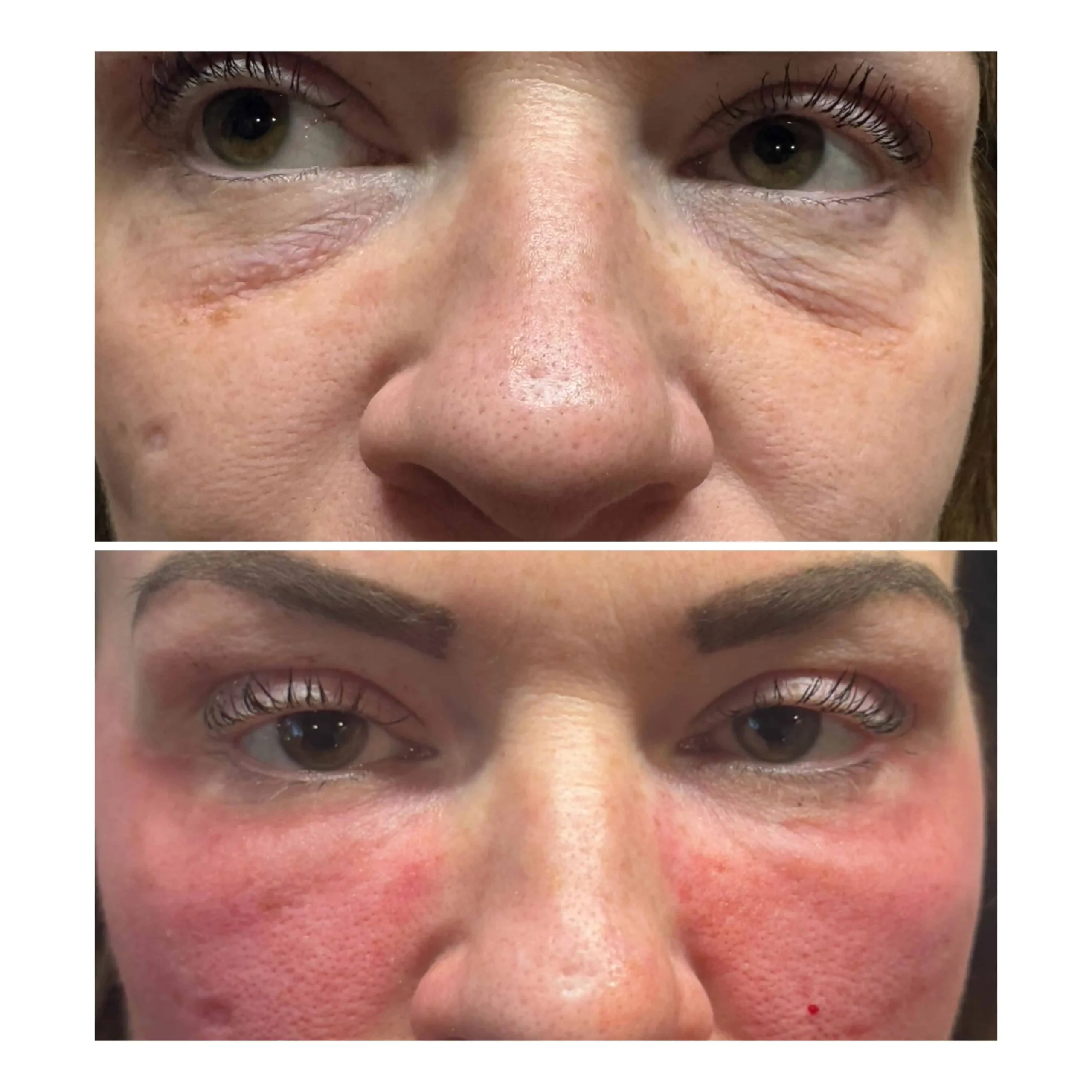NOUVADerm™-Treatment-Before-After