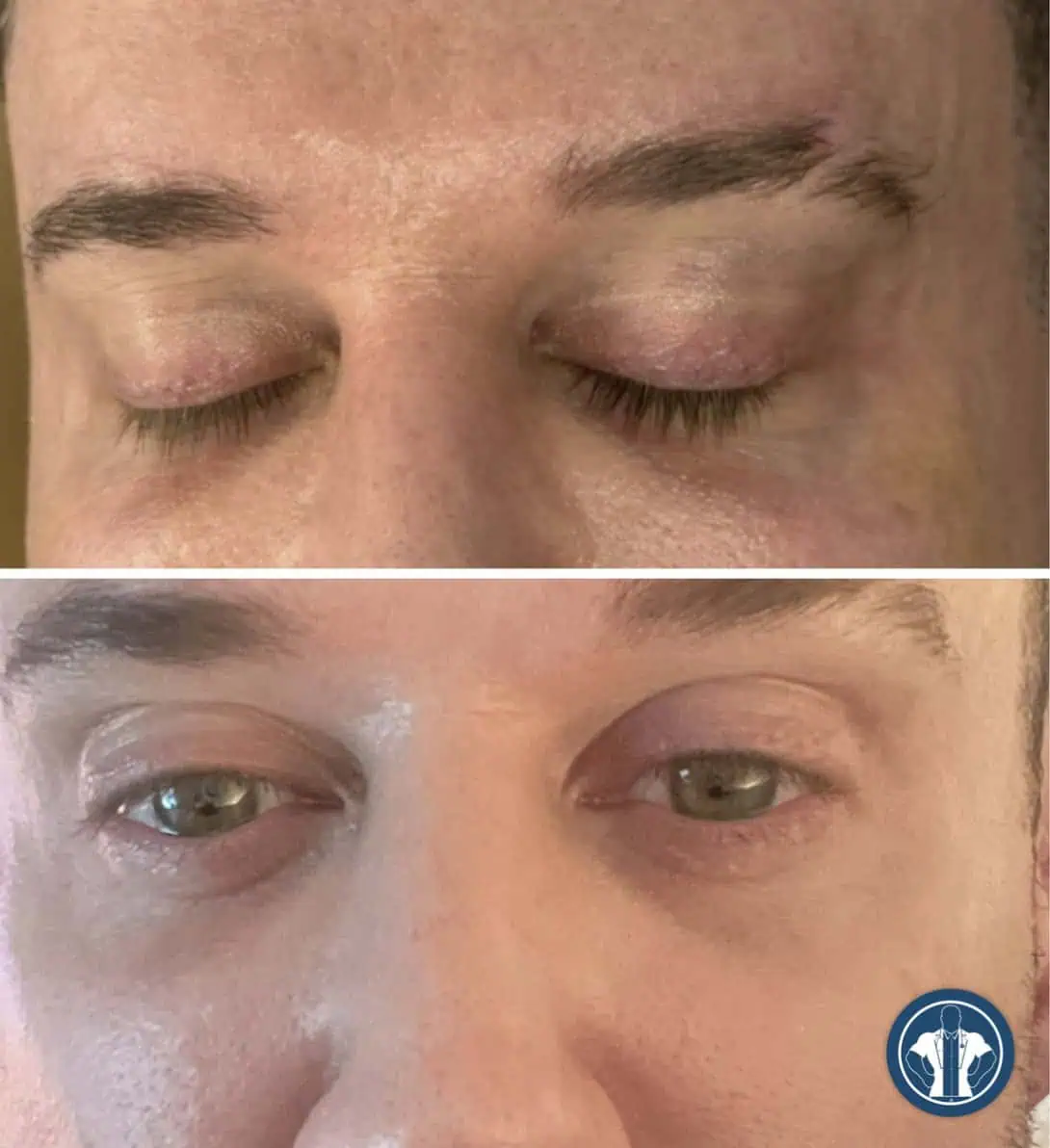 Undereye-gentle-giant-care-before-after-four