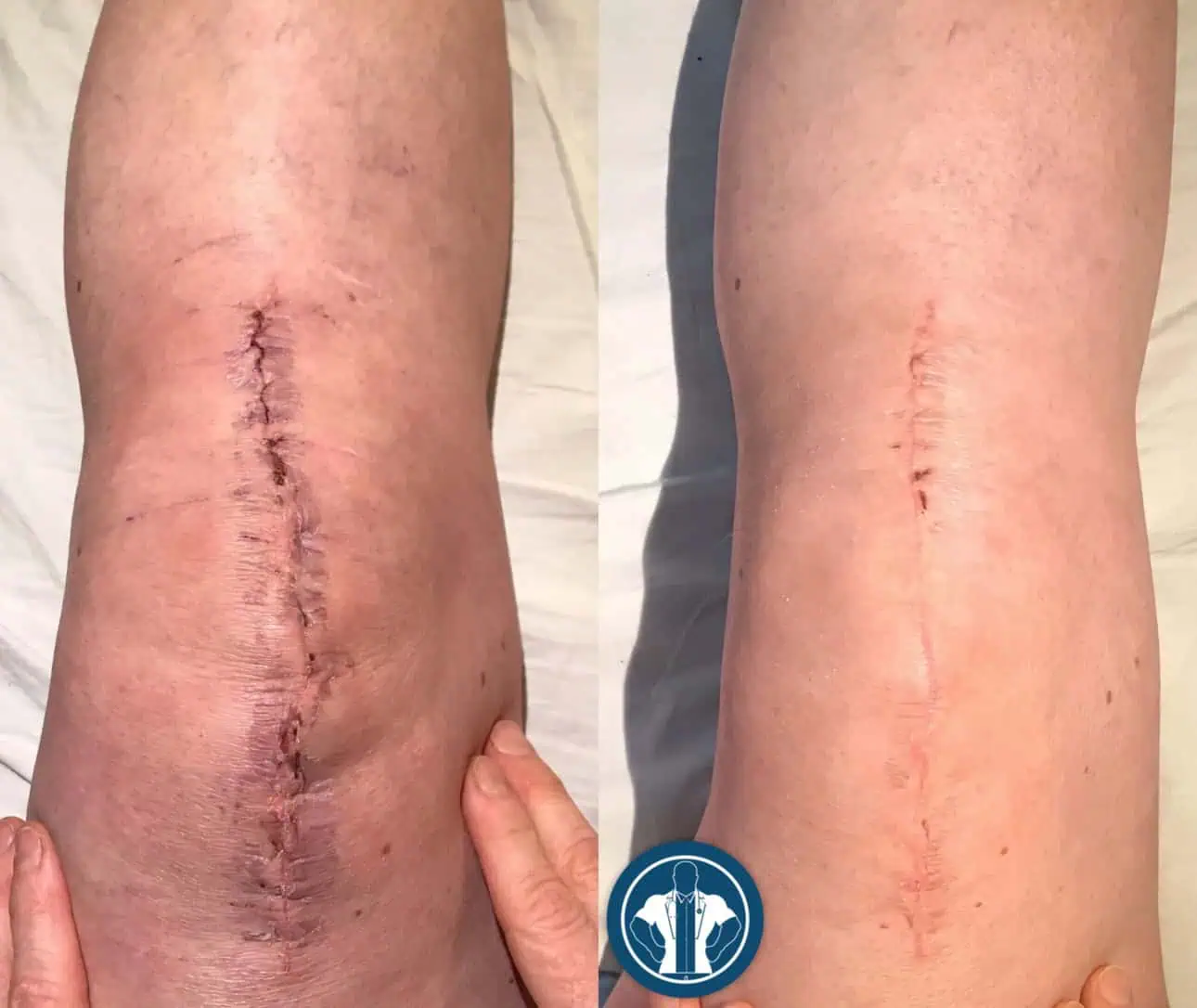 Wound healing gentle-giant-care-before-after-five
