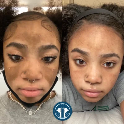 Before and After results of NOUVADerm™ Treatment in Atlanta, GA at Gentle Giant Care