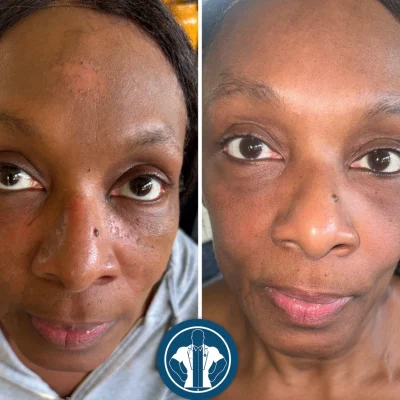 Before and After results of NOUVADerm™ Treatment in Atlanta, GA at Gentle Giant Care