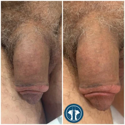 NOUVADerm™ treatment before and after results on penis at Gentle Giant Care in Atlanta, GA