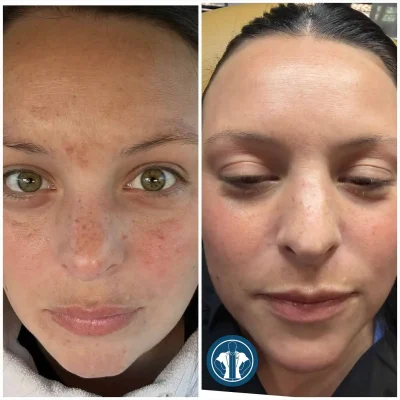 NOUVADerm™ facial skin treatment before and after results at Gentle Giant Care in Atlanta, GA