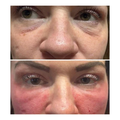 NOUVADerm™ undereye skin resurfacing before and after at Gentle Giant Care in Atlanta, GA