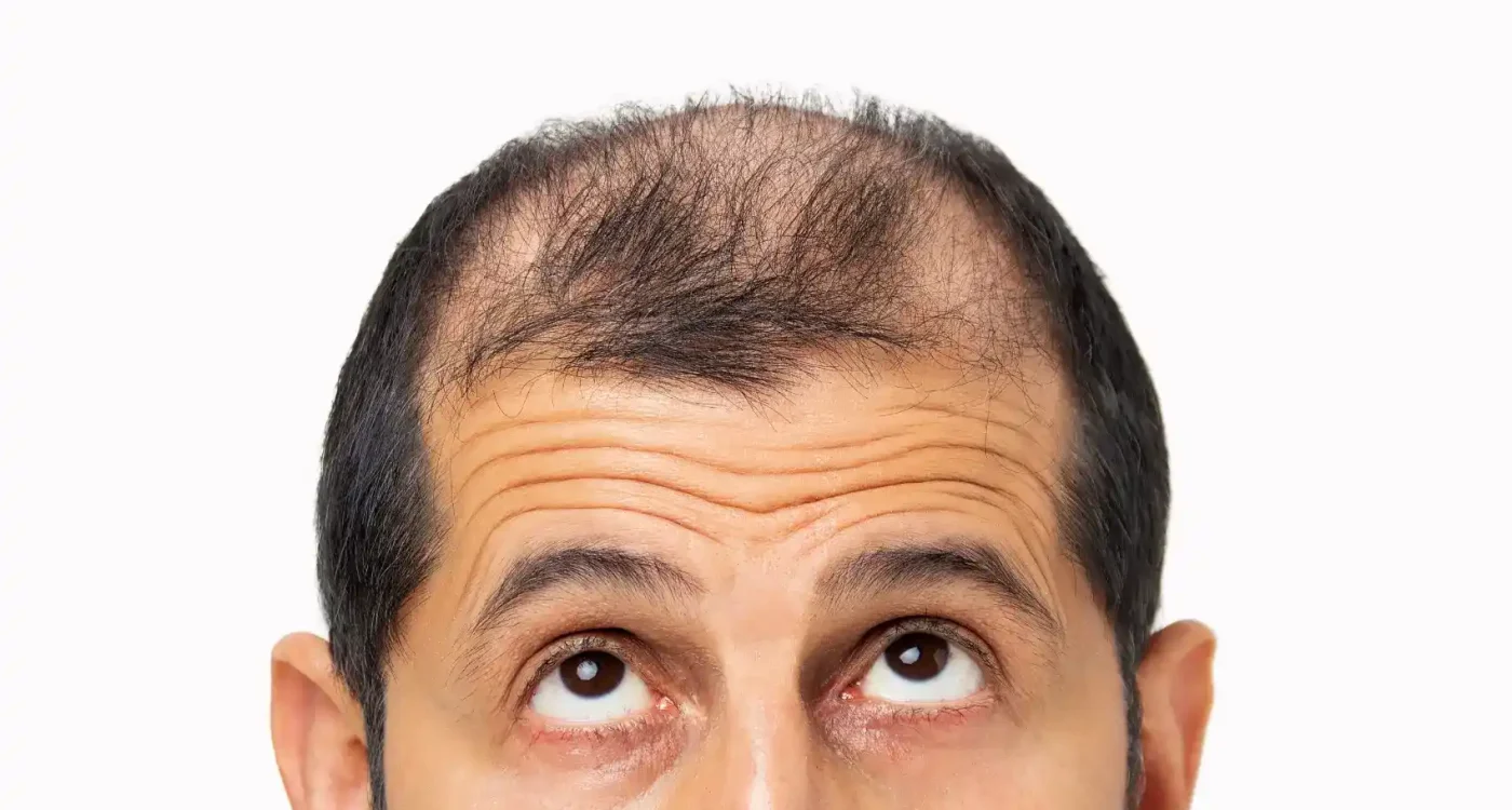 Pladuopro-hair-restoration-gentle-giant-care-llc--in-atlanta-GA