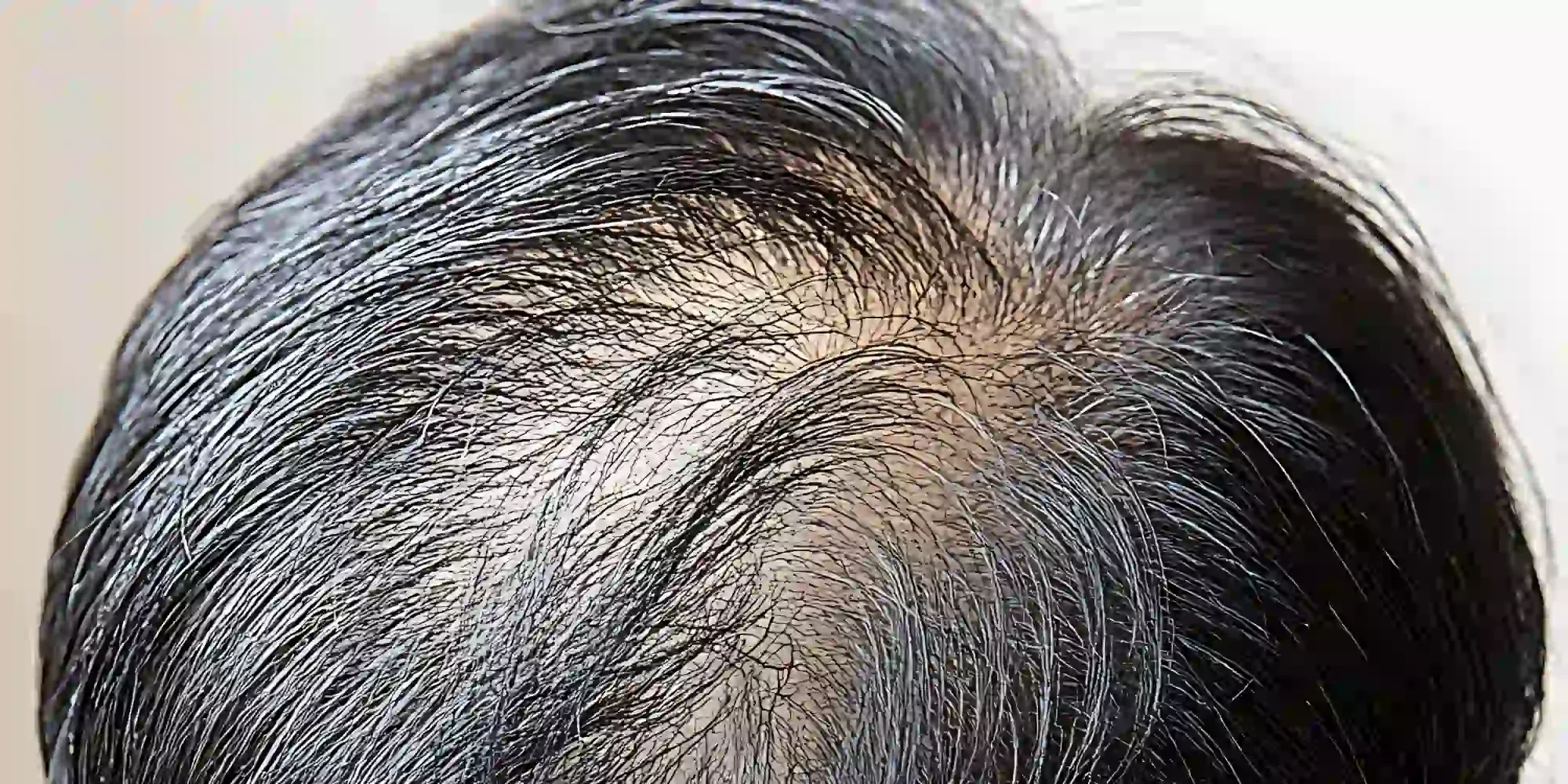 hair-transplant-gentle-giant-care-llc-in-palm-springs-ca