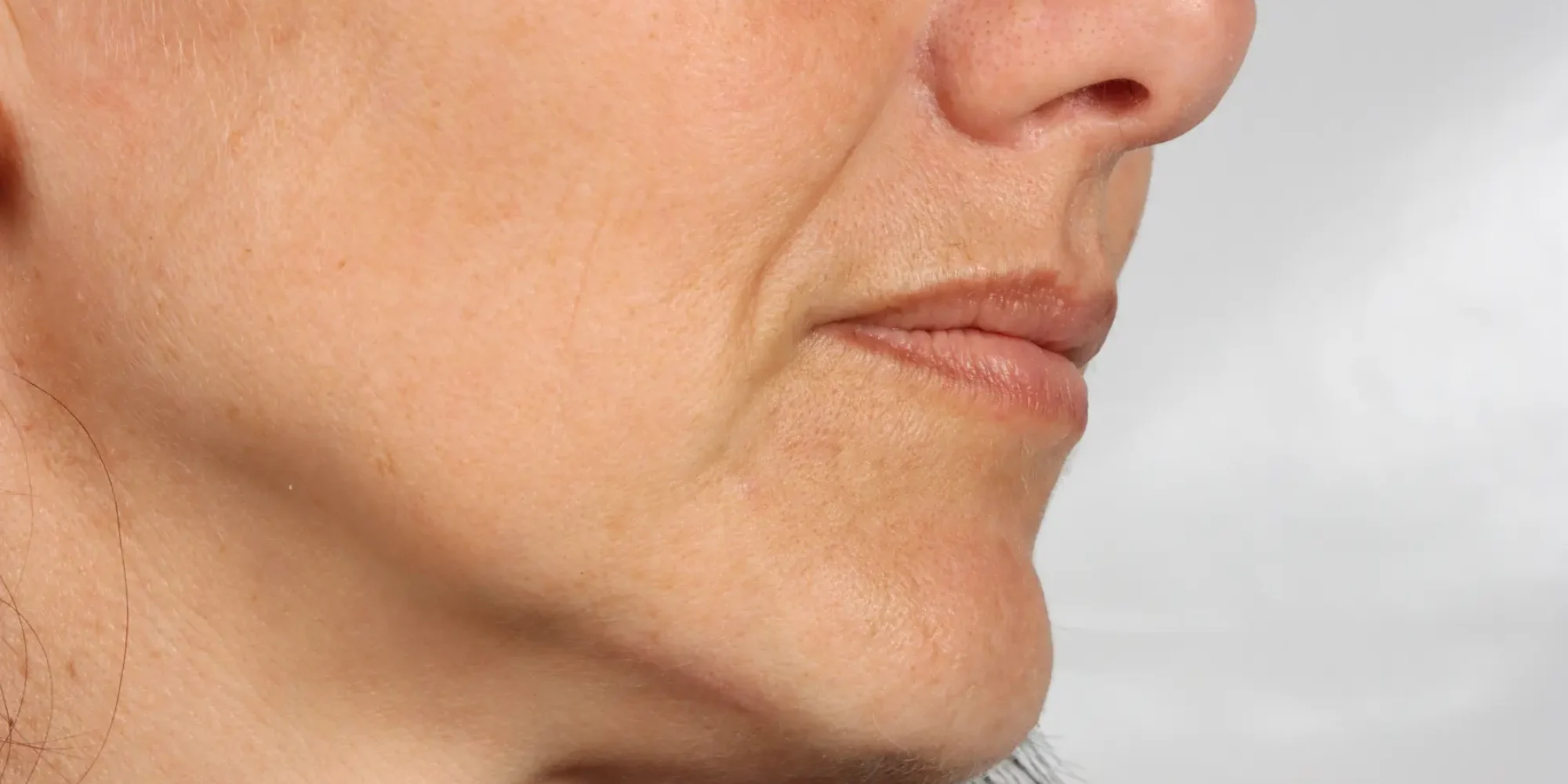 morpheus8-gentle-giant-care-llc-face-CA