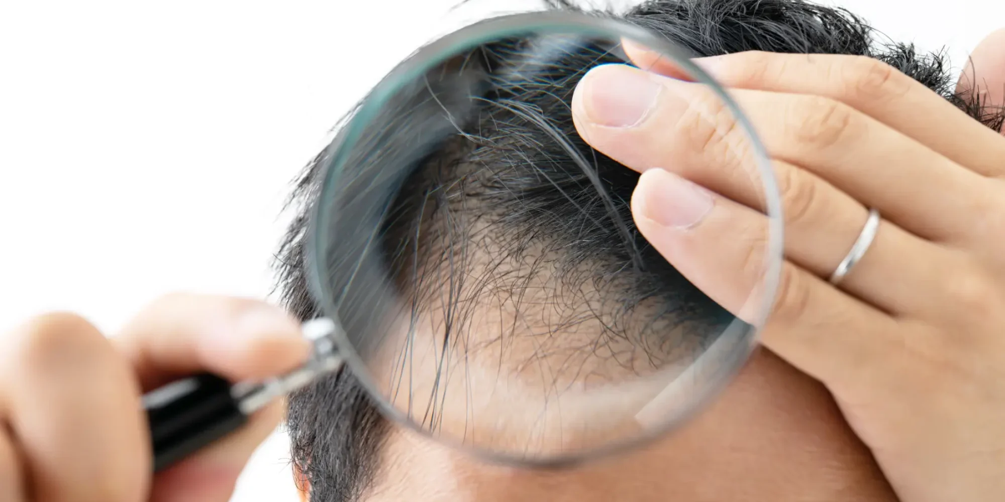 morpheus8-gentle-giant-care-llc-scalp-CA