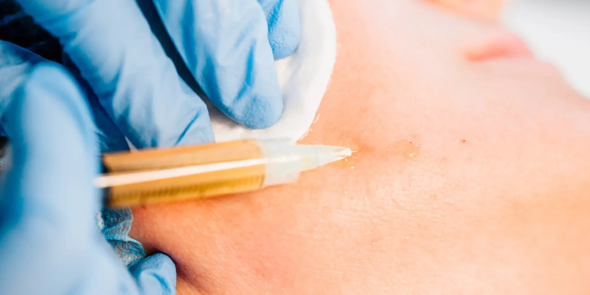 stem-cell-and-prp-injections-gentle-giant-care-llc-face-CA