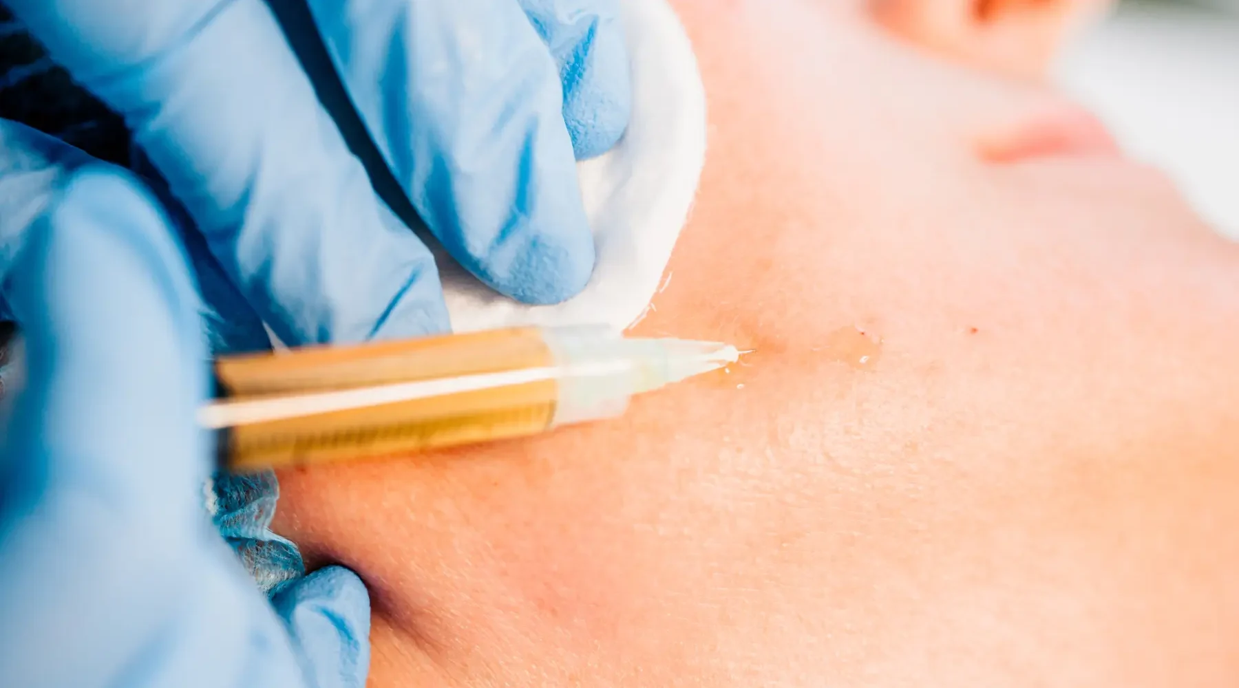 stem-cell-and-prp-injections-gentle-giant-care-llc-face-in-palm-springs-ca