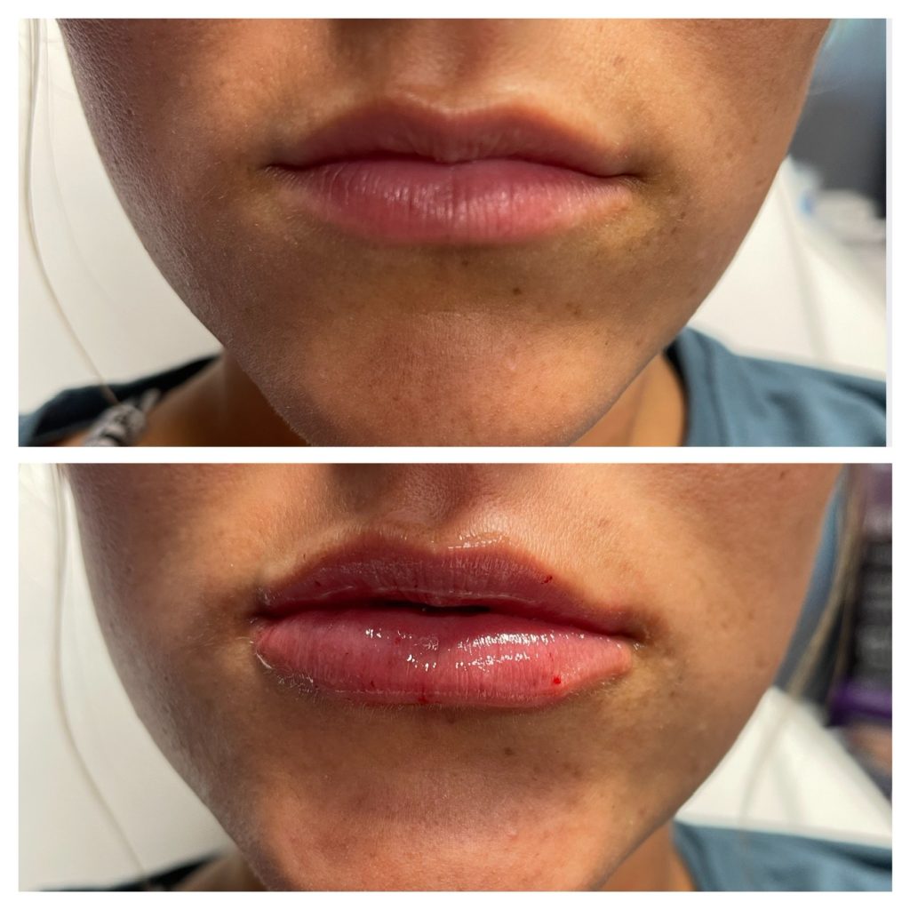 Dermal Fillers for lips Before and after images, Treatment in Atlanta GA