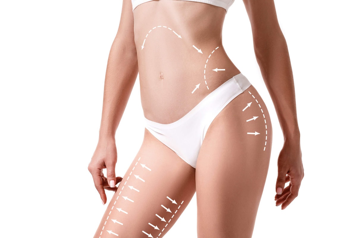 Is Liposuction Safe What to Expect, Risks, and More
