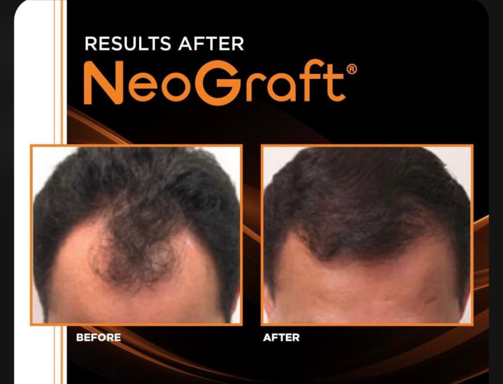 Hair Implant/Restoration 5 IMG 9356