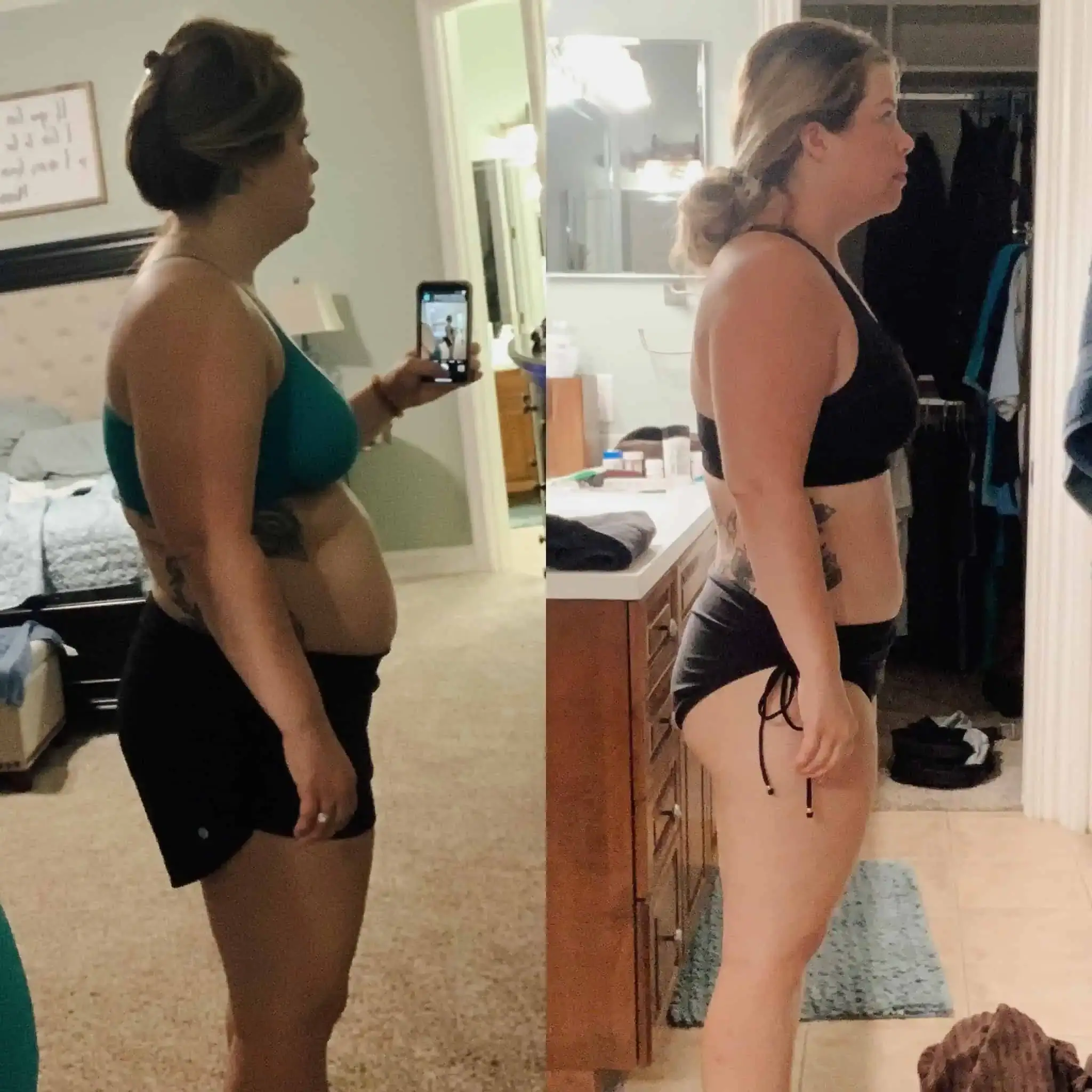 Before and After Weight Loss | Gentle Giant Care In Atlanta, GA, Lauderdale and Miami, FL