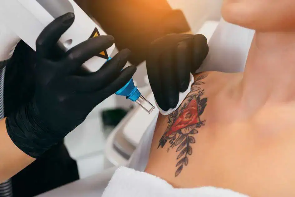 Laser Tattoo Removal Services in Atlanta, GA by Gentle Giant Care