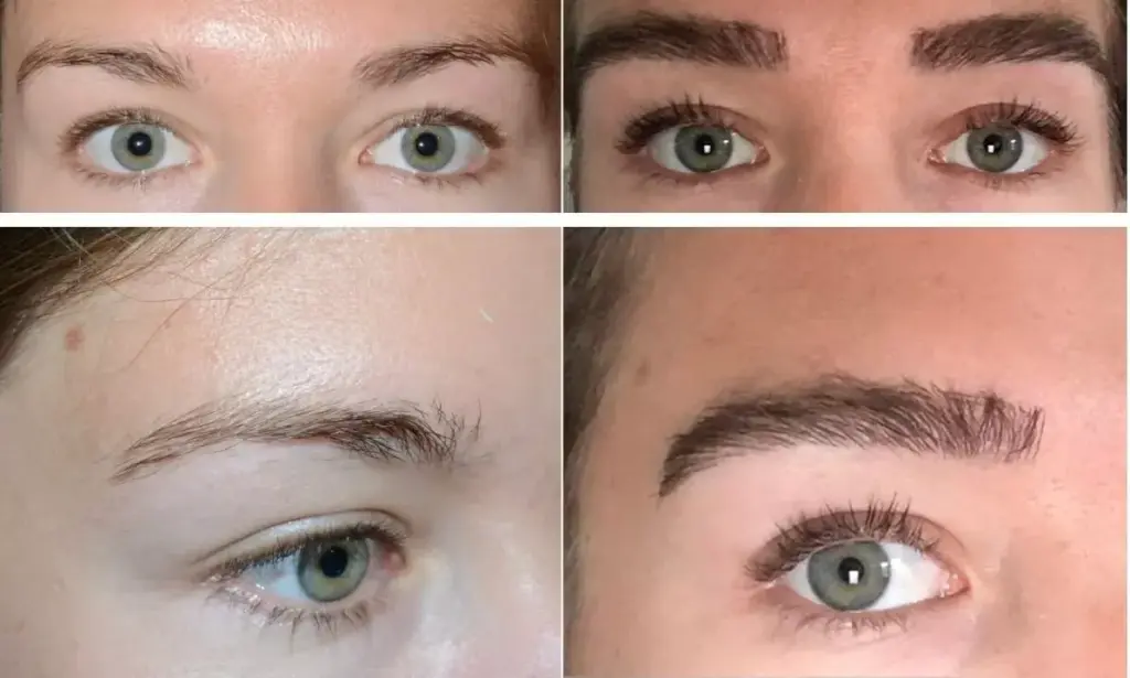 Hair Restoration before and after results eye brow at Gentle Giant Care in Atlanta, GA and Beverly Hills, CA
