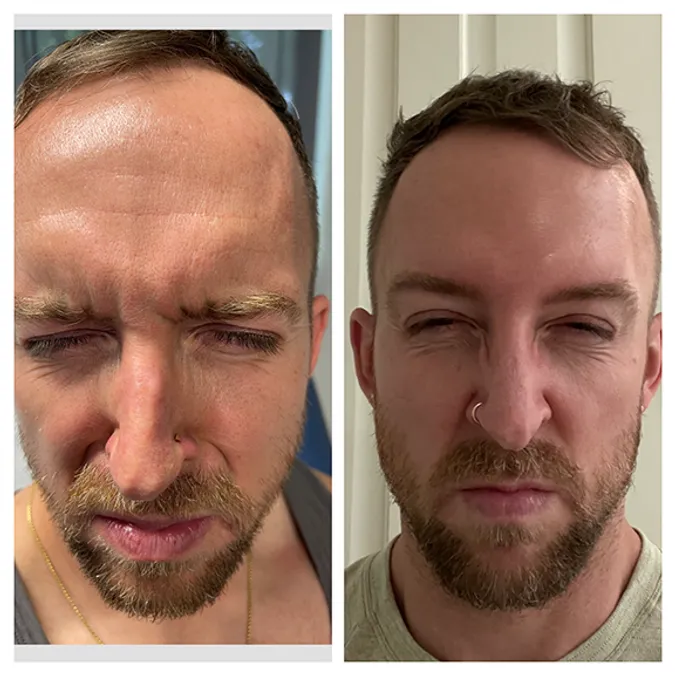 Botox before and after results for forehead wrinkle reduction and skin smoothing at Gentle Giant Care in Palm Springs, CA.