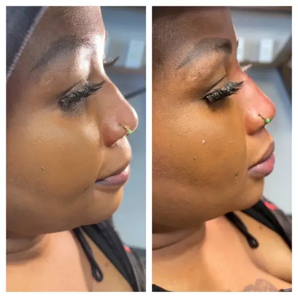 “Before‑and‑after comparison of dermal filler treatment at Gentle Giant Care LLC in Atlanta, Georgia — illustrating facial enhancements and improvements in volume or contour after cosmetic filler procedures.”